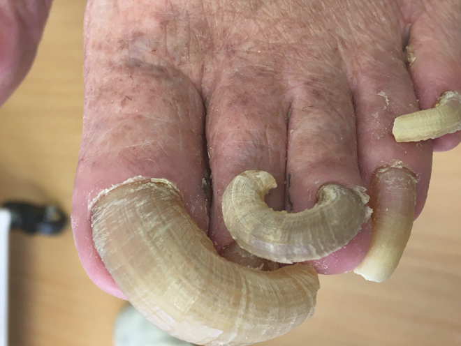 [変形した爪の写真1]