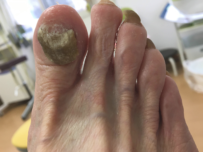 [変形した爪の写真2]